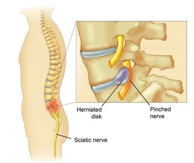 Chiropractic Care for Pinched Nerve