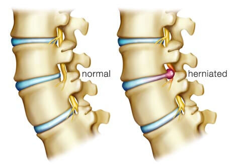 Chiropractic Care for Herniated Disc